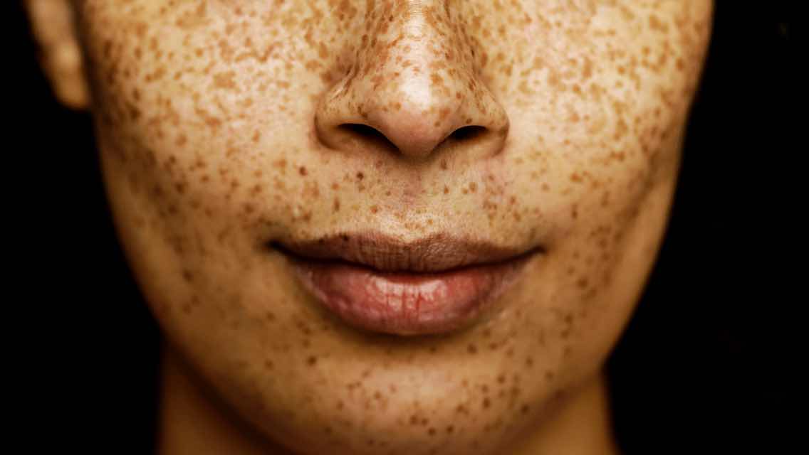 A close up of a woman's face who has a large amount of freckles.