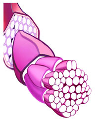 illustration of tendonitis