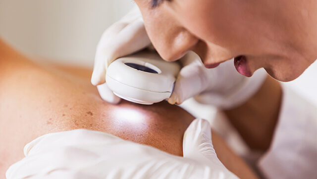 Doctor examining mole