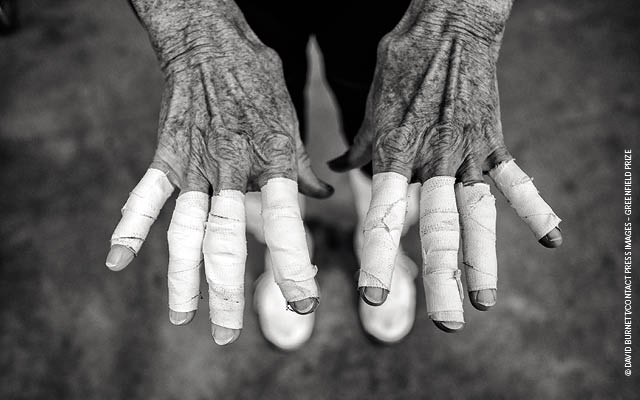 elderly hands taped