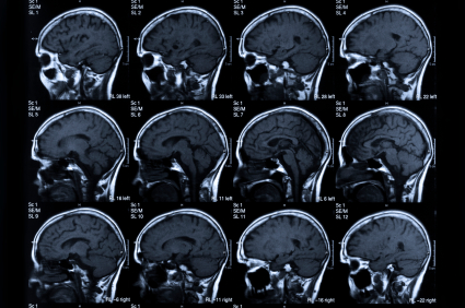A scan of a brain, showing 12 pictures, is shown.