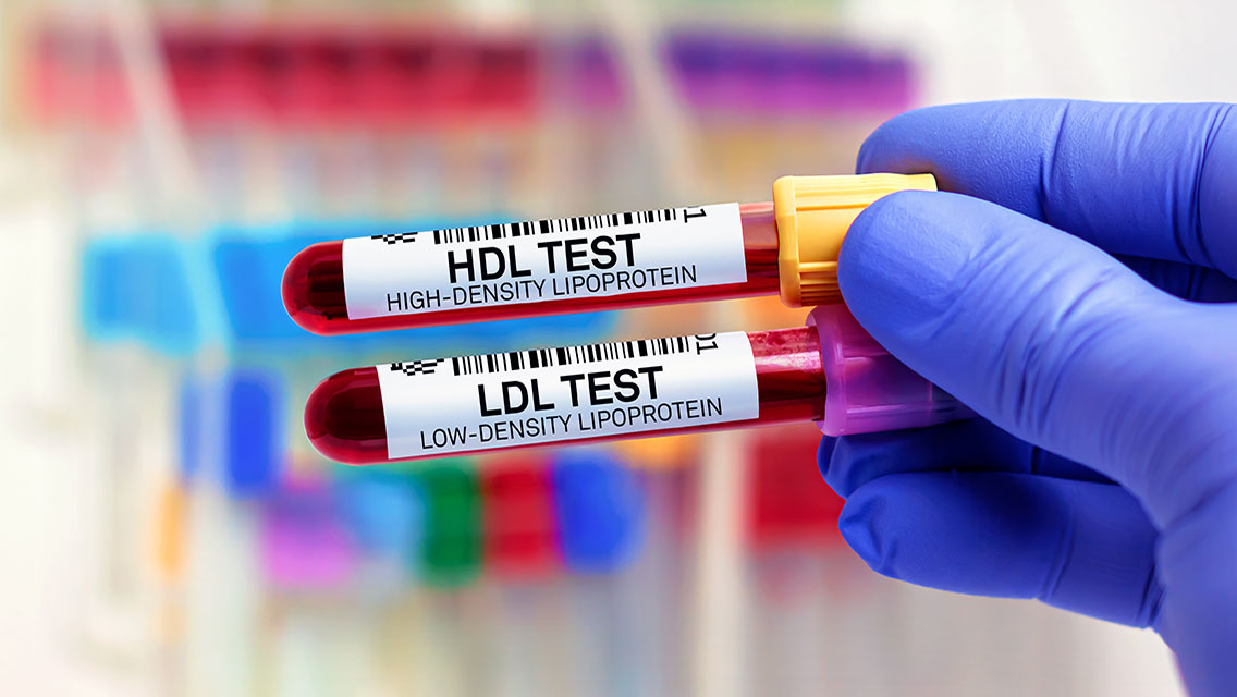 test tubes labeled HDL test