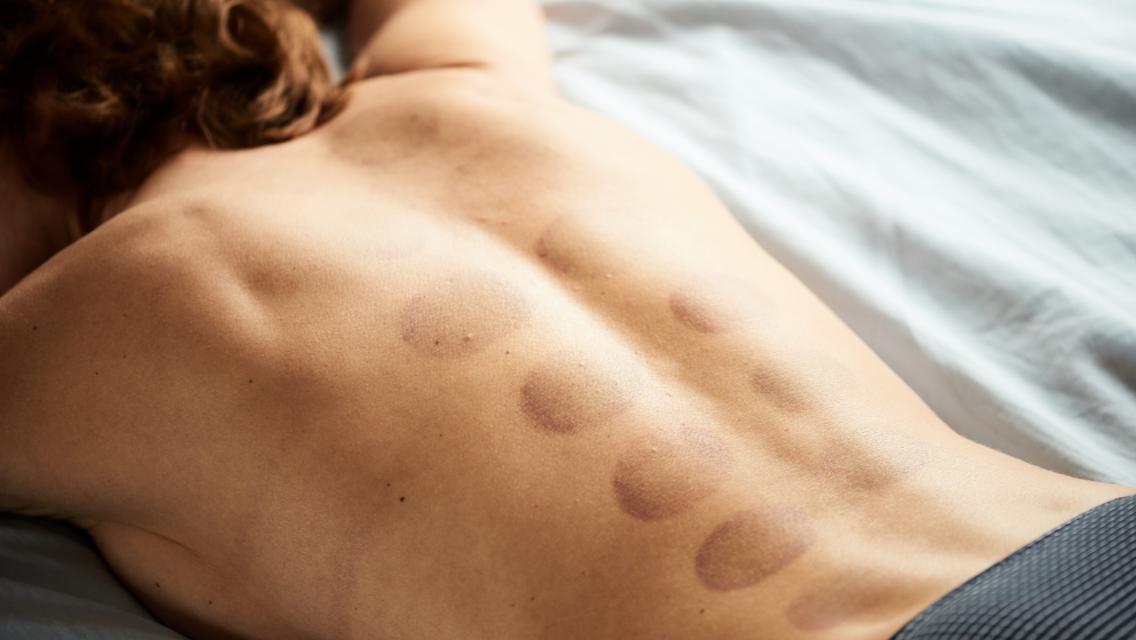 Woman lying face down on a massage table with cupping marks on her back