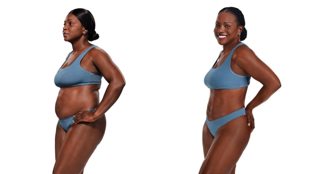 coolsculpting before and after photo