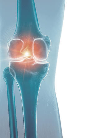 Illustration of a painful knee 
